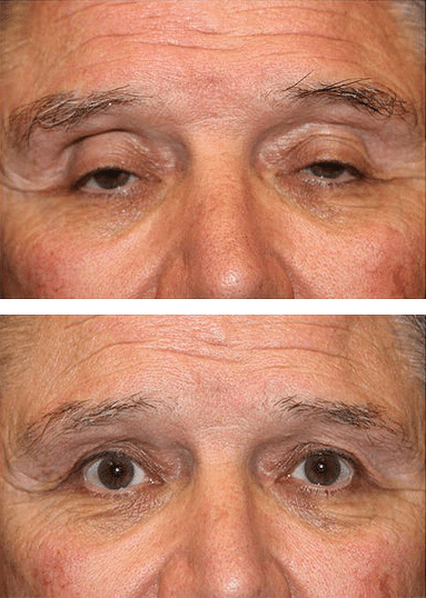 Droopy eyelid online surgery recovery time