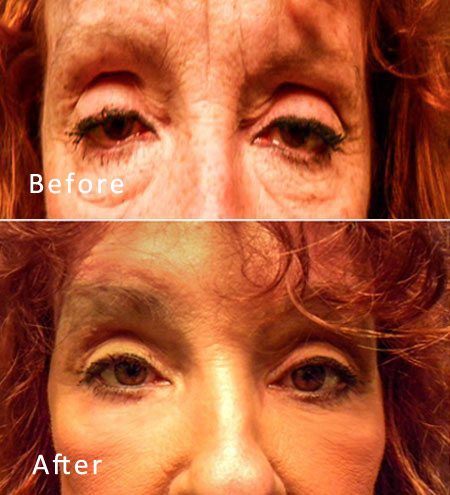 Best Dallas Blepharoplasty