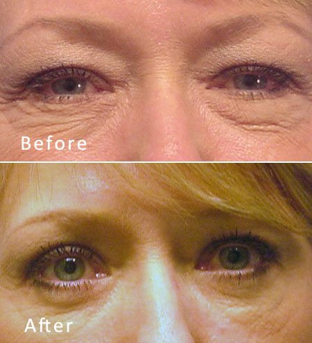 Best Dallas Blepharoplasty