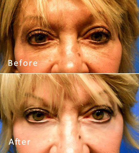 Best Dallas Blepharoplasty