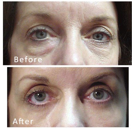 Best Dallas Blepharoplasty