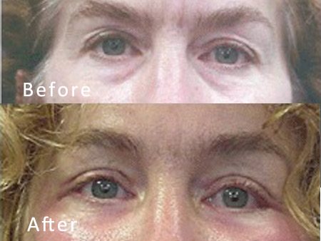 Best Dallas Blepharoplasty